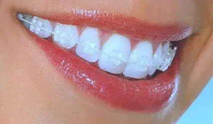 clear braces