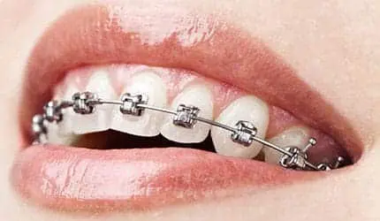 metal braces