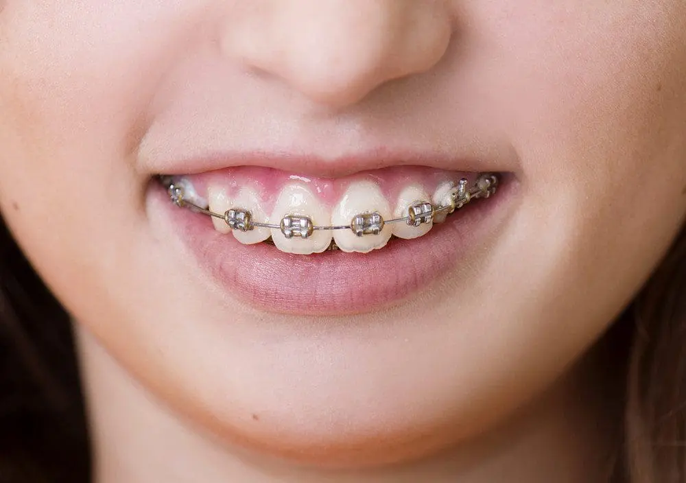 Braces vs. Invisalign: Which Is Best for You?